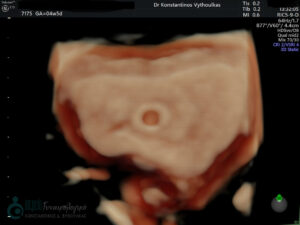 σάκκος κύησης 3D