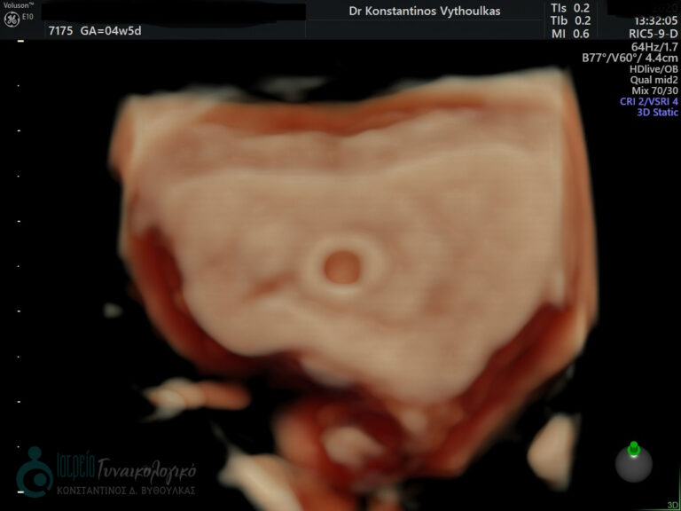 σάκκος κύησης 3D